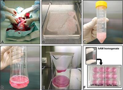 Detrimental Effect of Various Preparations of the Human Amniotic Membrane Homogenate on the 2D and 3D Bladder Cancer In vitro Models